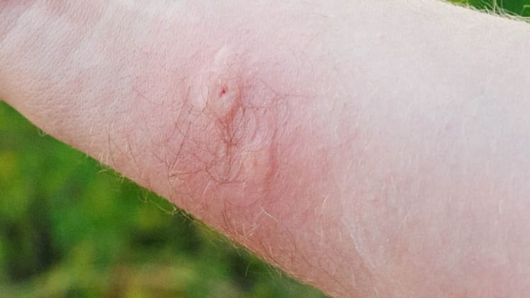 Insect and spider bites and stings — serious