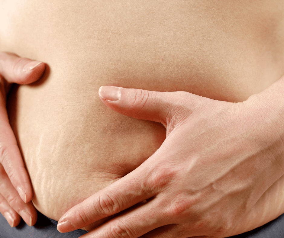 Can Stretch Marks Be Covered Up?
