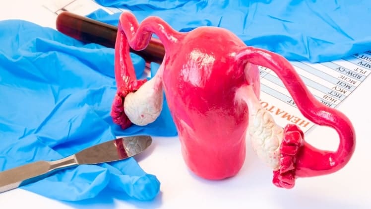 Uterine Fibroids and All They Entail