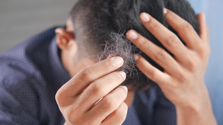 Minoxidil for Hair – Benefits and How to Use It