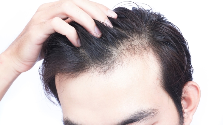 Women’s Hair Loss – Why It Happens