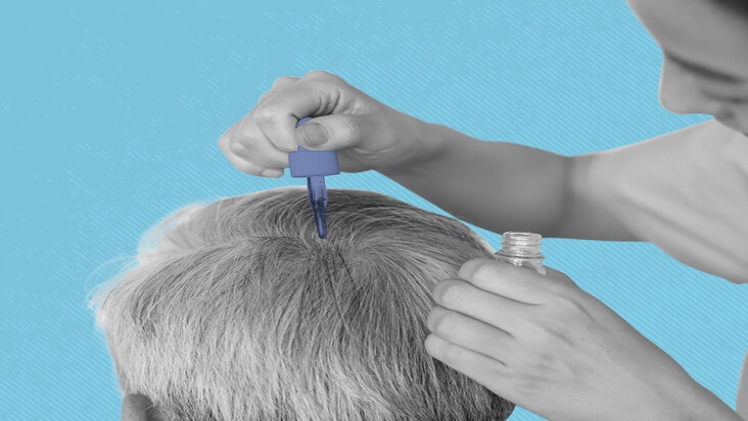 There’s Finally a Minoxidil Shampoo on The Market for Women
