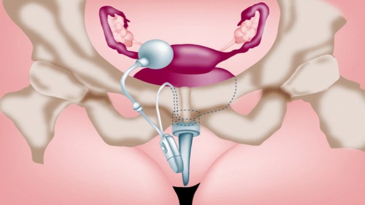 Non-surgical therapy for urological incontinence